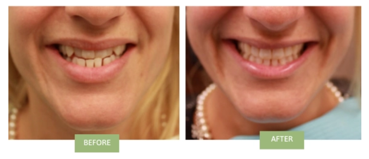 Invisalign NYC - Underbite Before & After