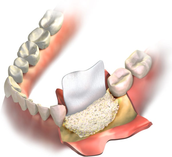 Bone Grafting of Lower Jaw