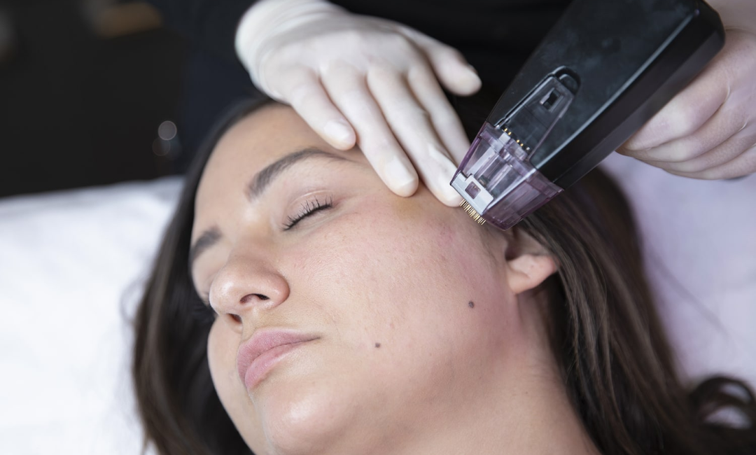 how long does morpheus8 last