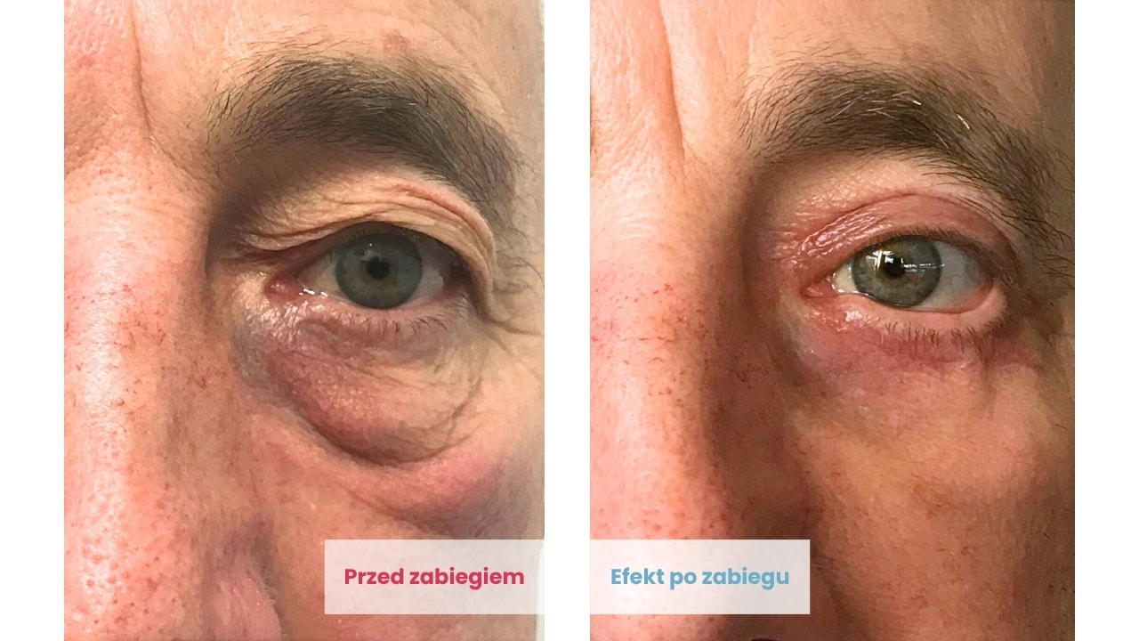 Efekty plastyki powiek dolnych u Pacjenta