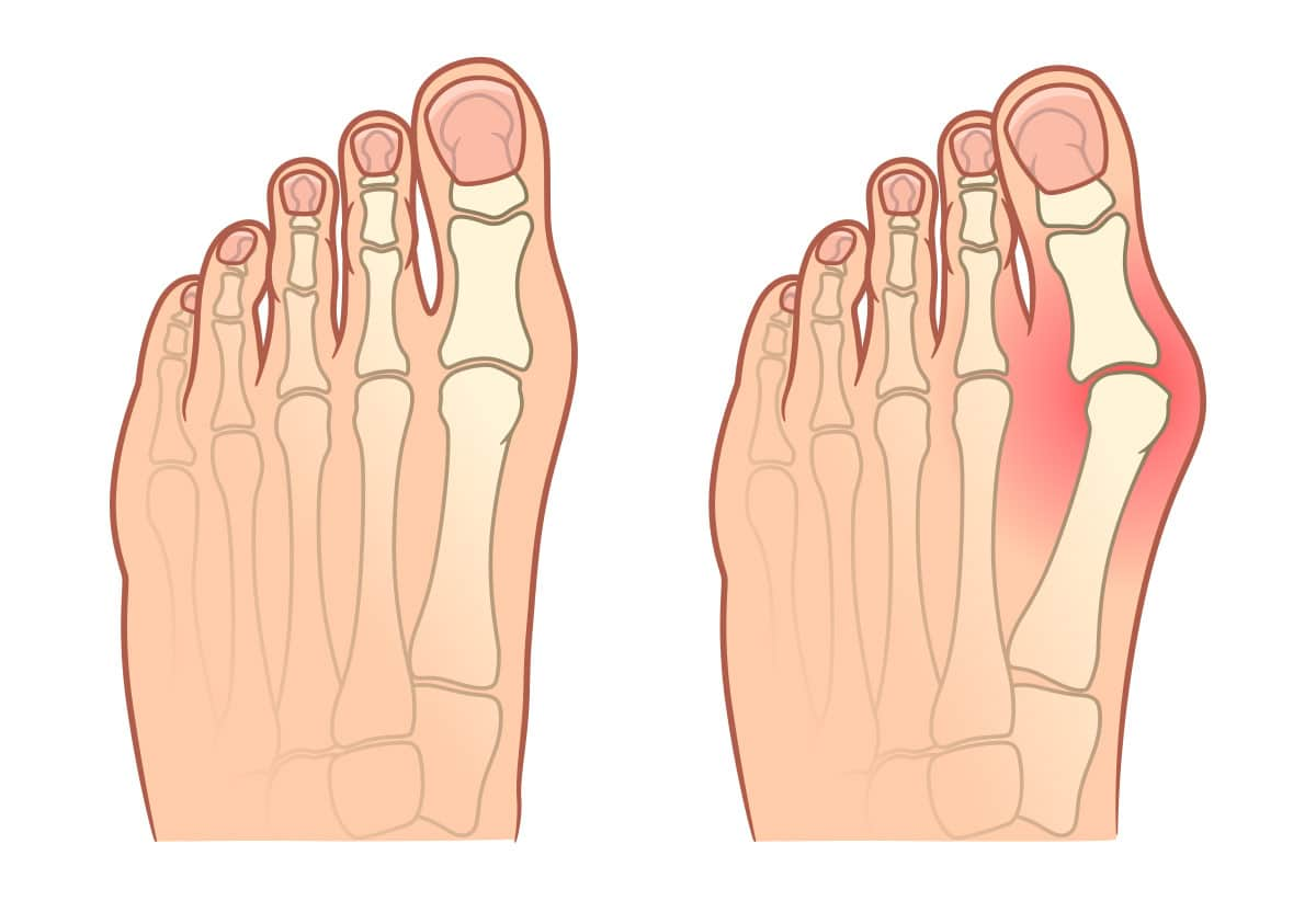 Hallux valgus
