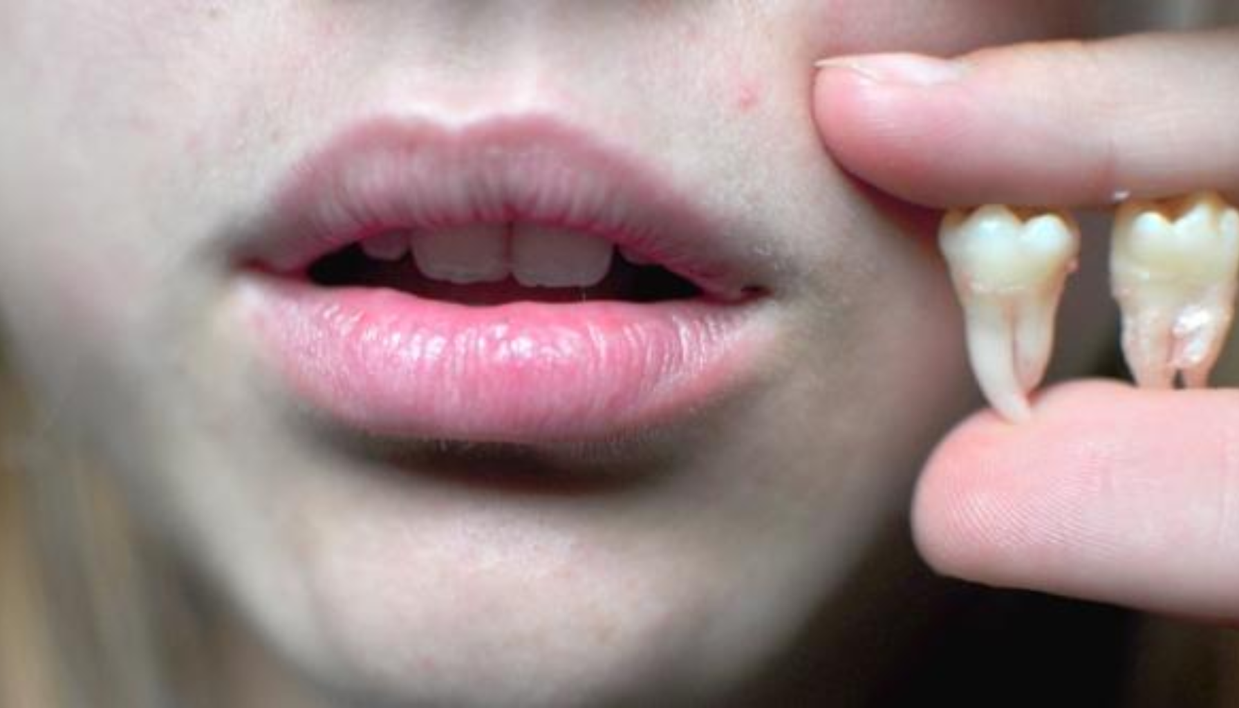 Visdomstenner: Når De Kommer, Hvorfor De Går 17 Nærbilde av en person som holder to utdratt visdomstenner mellom fingrene, med delvis åpne lepper i bakgrunnen.