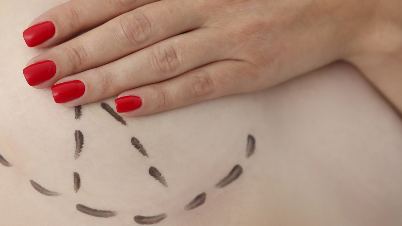 What is breast augmentation?