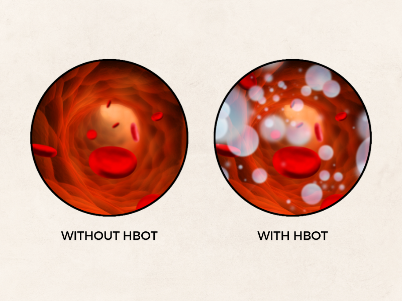 Image showing the mechanism of hyperbaric oxygen therapy.