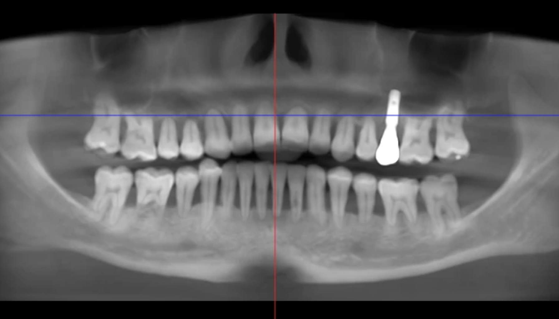 Panoramarøntgen av menneskelig kjeve viser alle tenner, med synlig tannimplantat øverst til høyre og markeringer for posisjonering.
