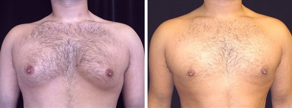A patient of Dr. Delgado with excellent skin elasticity : Before and after photo of gynecomastia surgery