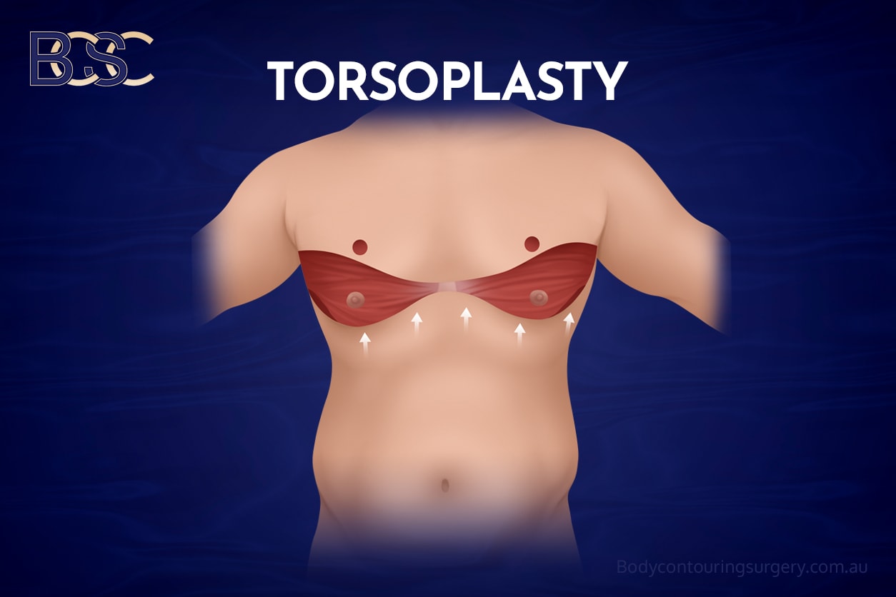 Anterior torsoplasty