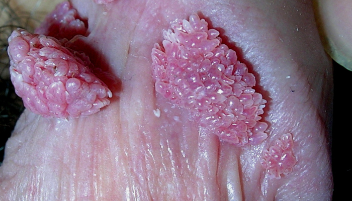 Verruga genital de color rosado