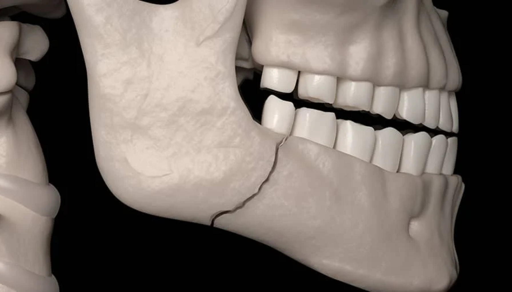 Digital illustrasjon av hodeskalle med brudd i underkjeven, tydelig sprekk i kjeveområdet.