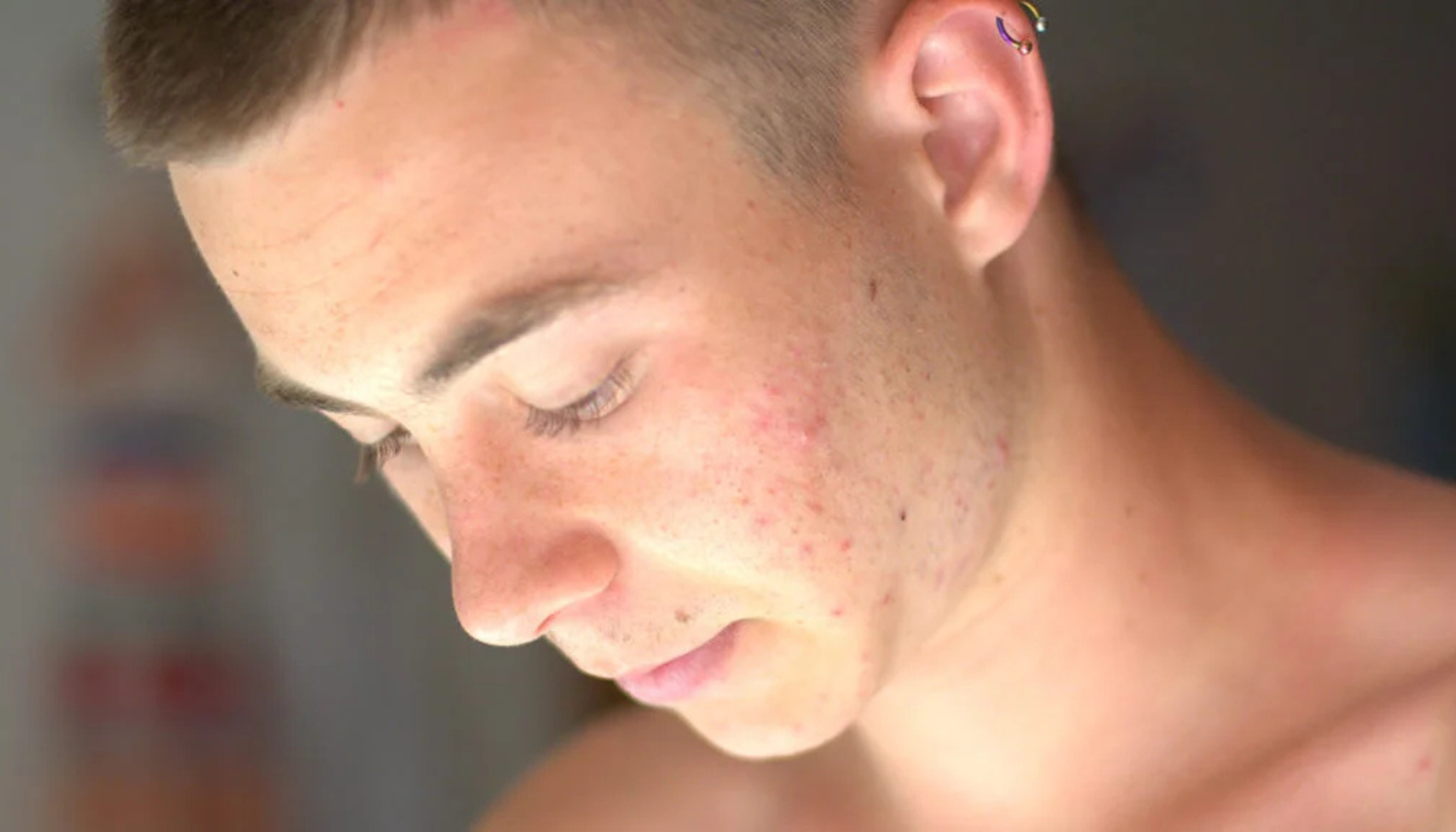 Ung mann med kviser og rødhet i ansiktet, ser ned med alvorlig uttrykk. Bildet illustrerer hudproblemer som akne eller uren hud. tretinoin krem hos dag god apotek