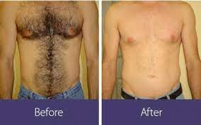 Hair Removal San Gabriel Los Angeles CA Laser Hair Removal