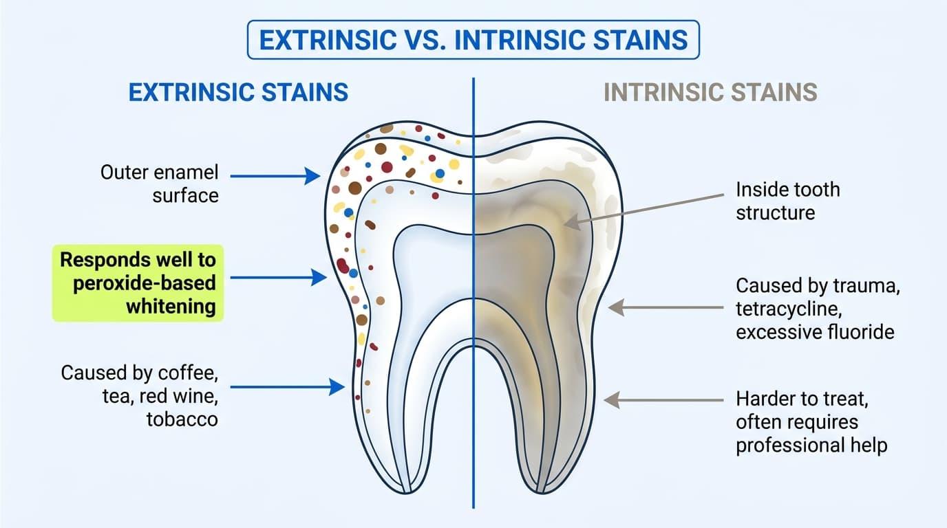 Extrinsic vs. Intrinsic Stains: Why the Difference Matters for Whitening