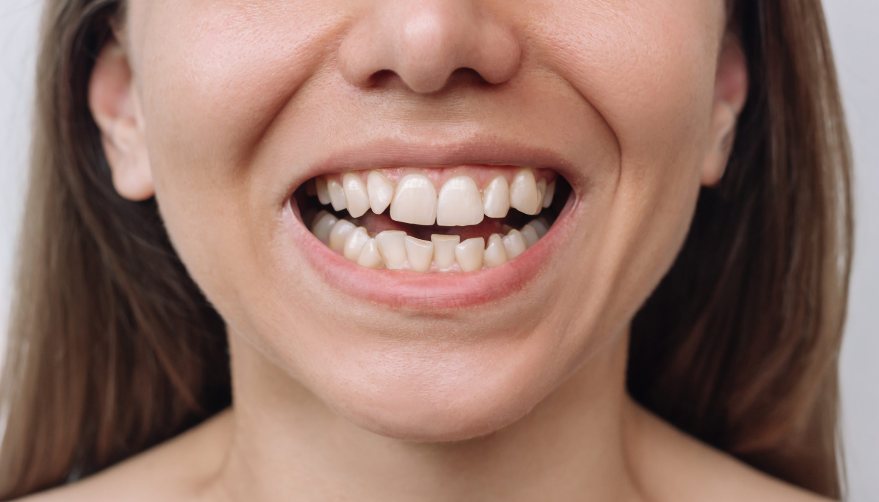 Skjeve tenner: Når estetikk og tannhelse henger sammen 11 Tenner med tydelig trangstilling og ujevn plassering i over og underkjeven hos smilende voksen kvinne. skjeve tenner tennene hos voksne tenner tennene dine rette tenner alternativer å velge flytte tennene bak tennene baksiden av tennene bevege seg tilbake mellomrom mellom tennene lang tid tennene beveger rundt tennene tannregulering skjeve åpent bitt regulering rette hos flytter behandling mellomrom tannen smil viktig mer kjeven dine voksne behandlingen usynlig tid tannlegen får flytte tann føre finnes problemer posisjon beste moderne gjør rundt andre litt hjelpe god bak naturlig alder invisalign derfor lenger fast gjøre feil helt bruke skinner periodontitt tilbake økt ulike gir flere ofte mindre vokser redusere tilbyr forebygging plass ønsker alternativer bedre dersom løse bitt