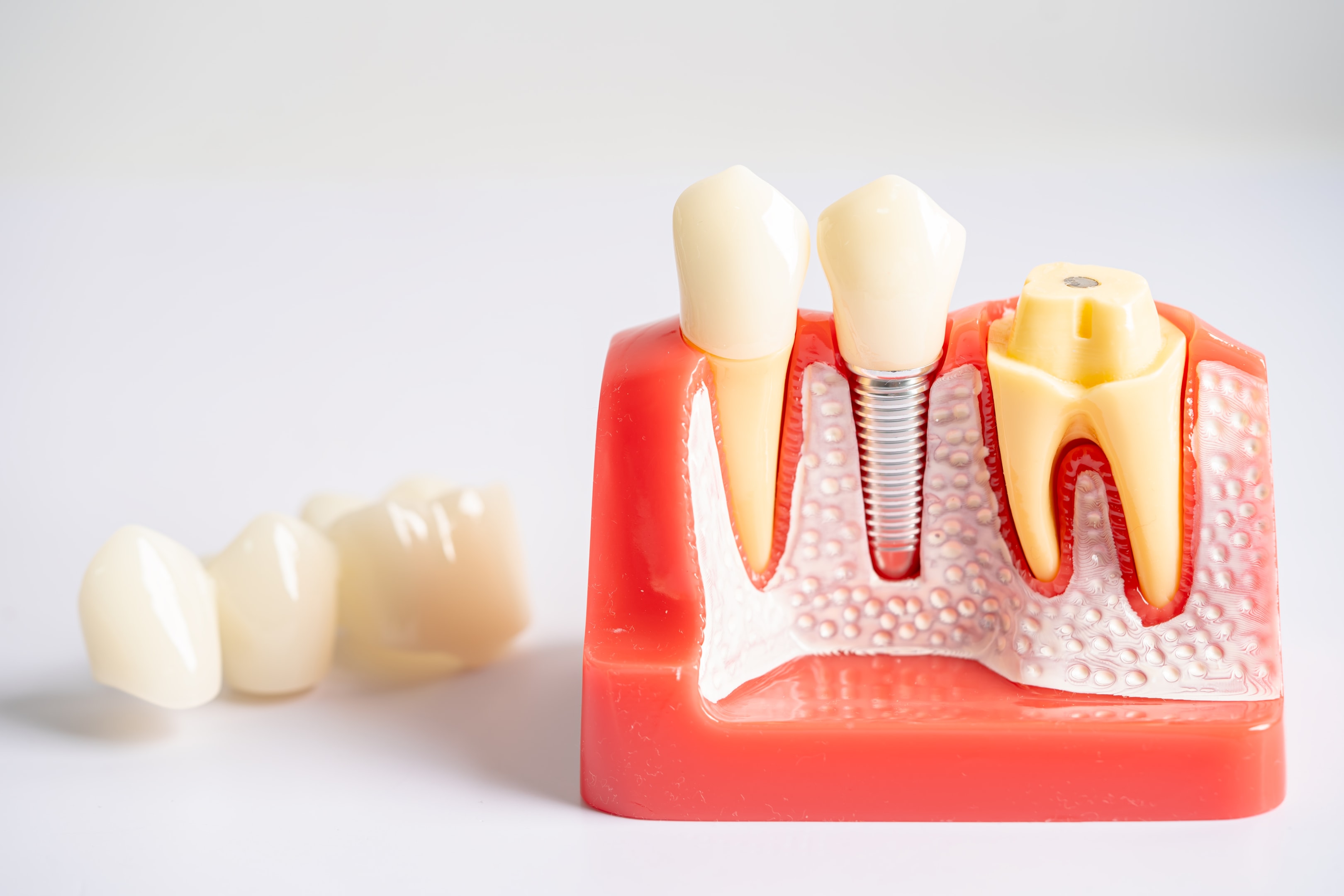 the difference between a dental implant vs crown. One covers your natural teeth and one replaces a missing tooth