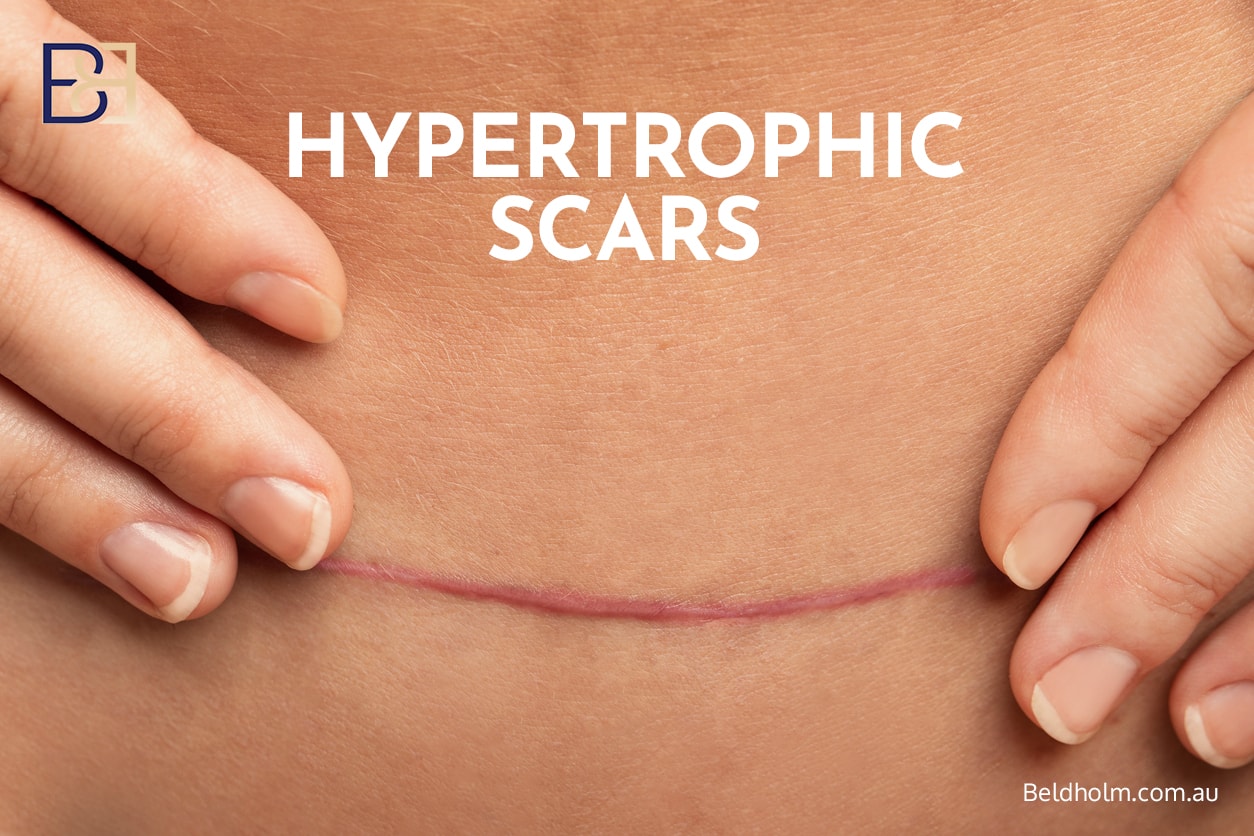 Hypertrophic scaring