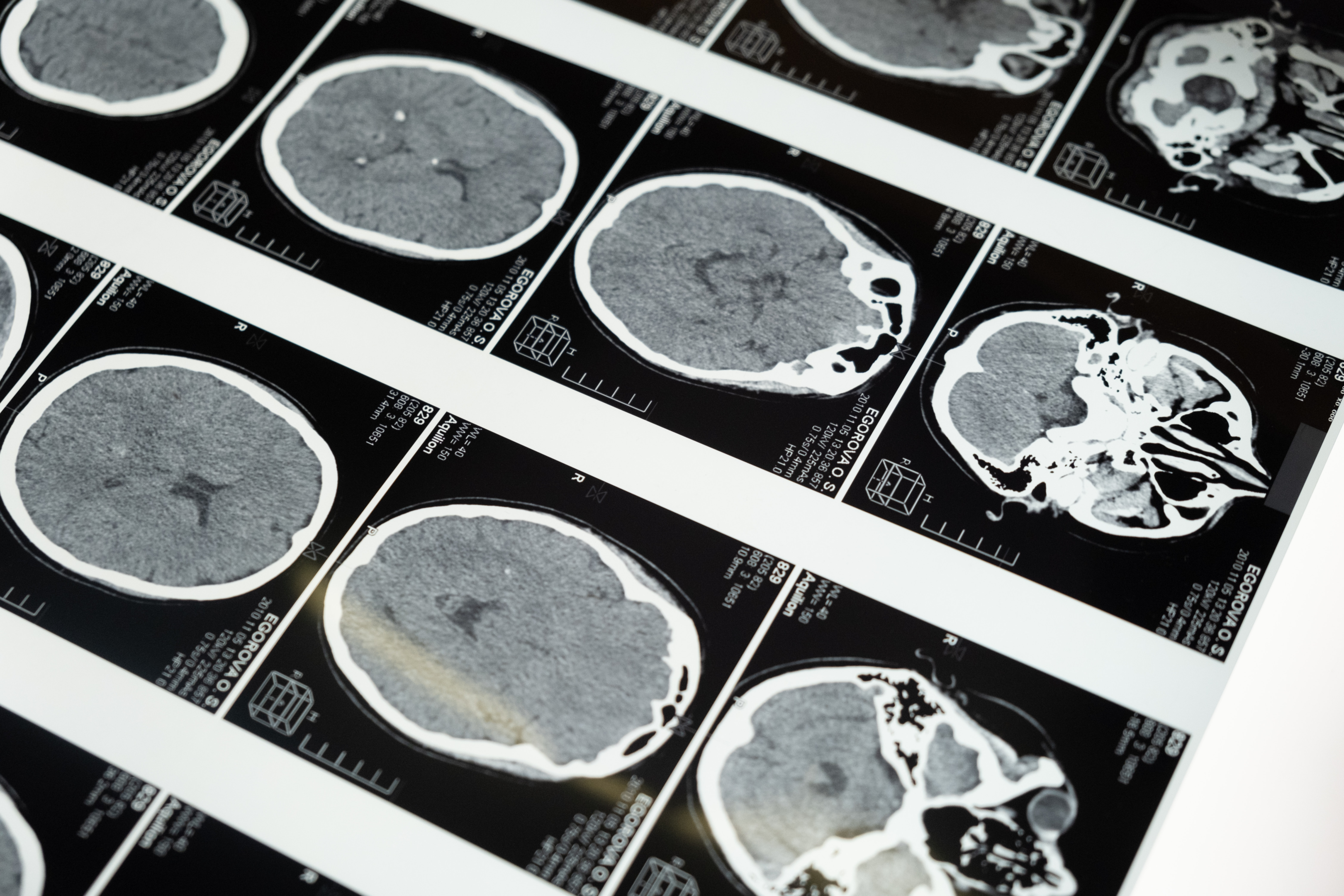 A Traumatic Brain Injury can Change a Person's Entire Life