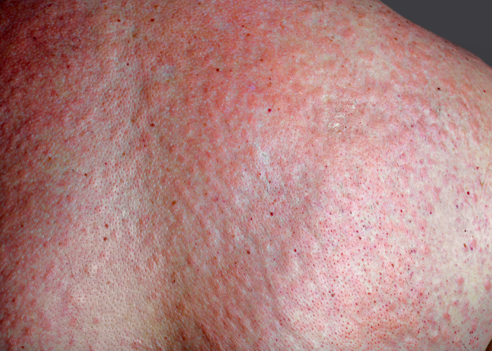 erupción cutánea con manchas rojizas en la piel
