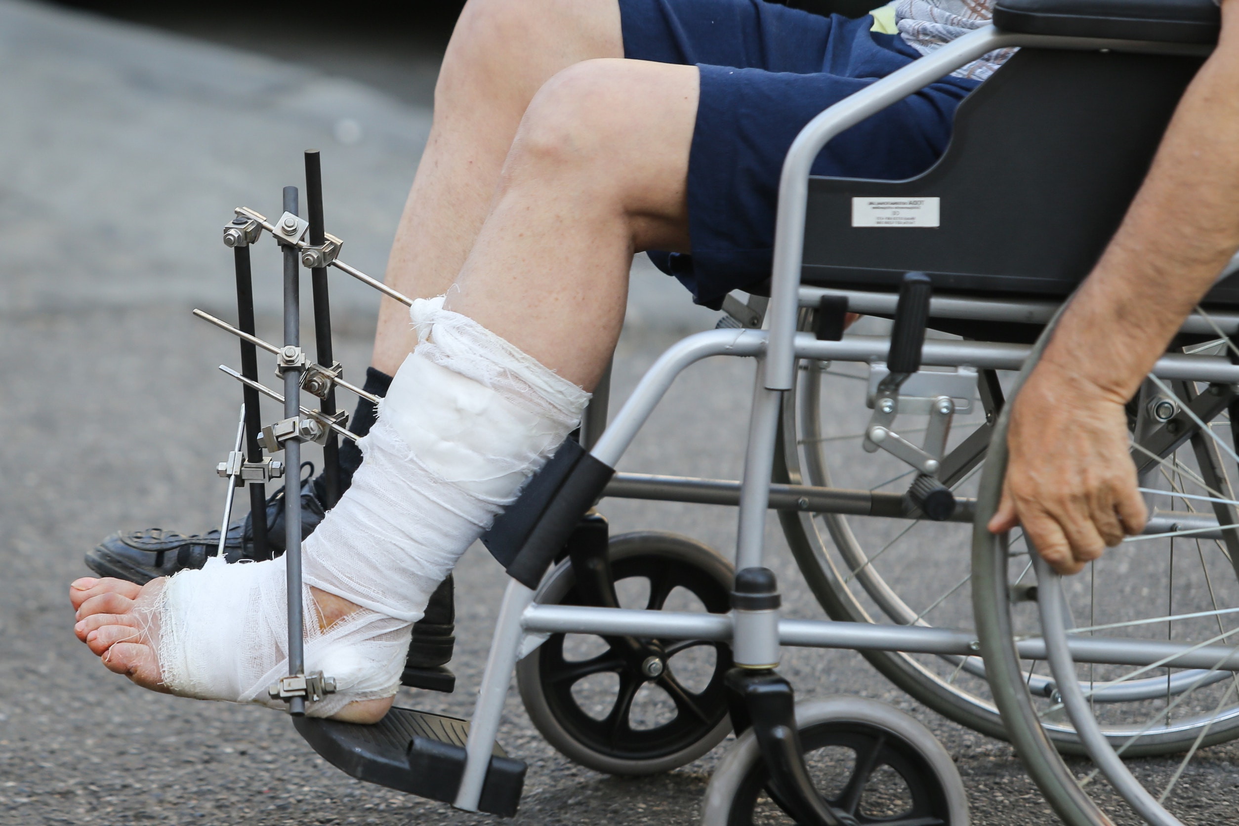 A man sitting in a wheelchair with pins in his leg after a serious injury