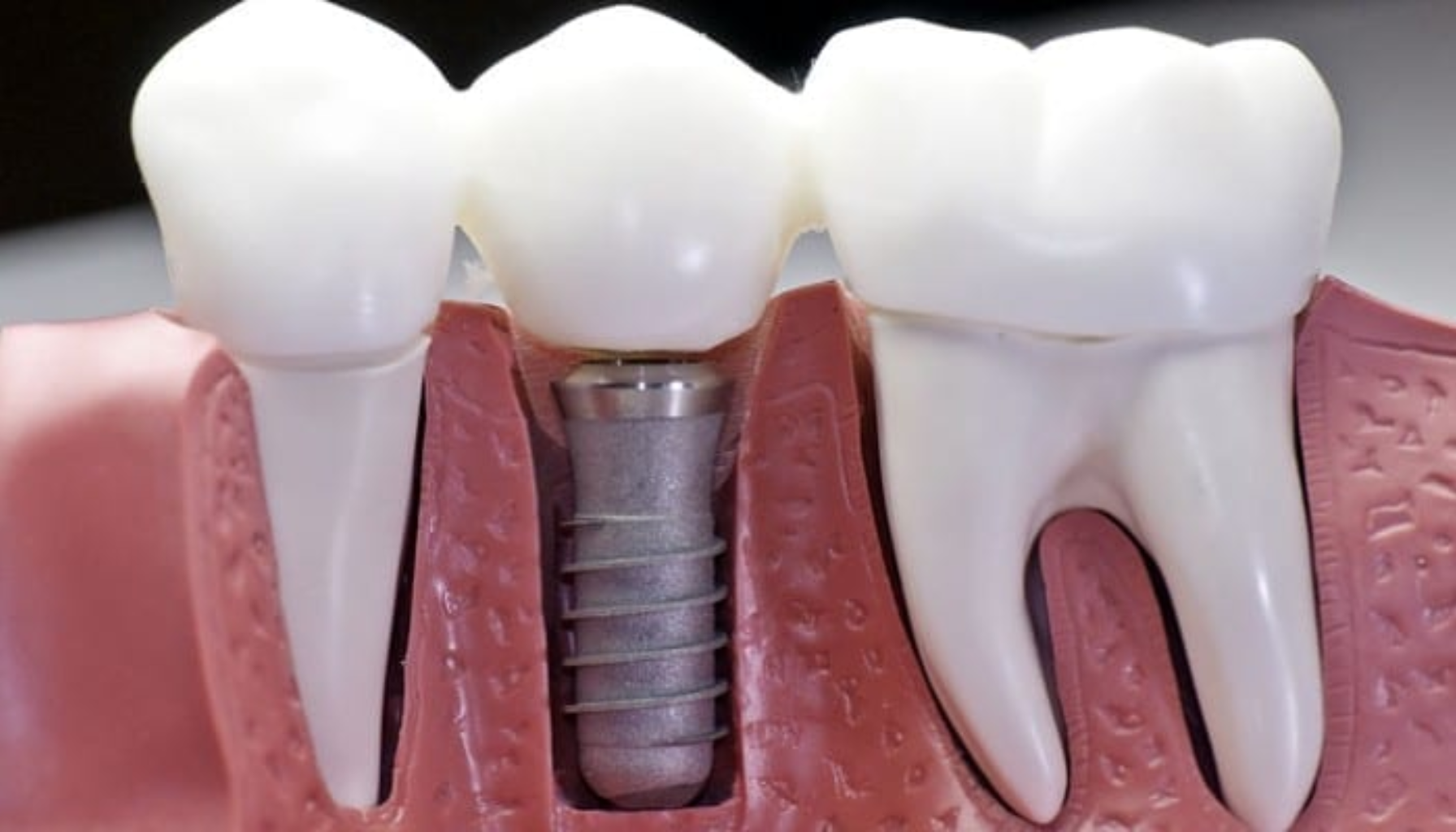 Nærbilde av en tannimplantatmodell som viser hvordan implantatet er festet i kjevebenet mellom naturlige tenner. tann på stift stift og krone rotfylt tann bygges opp igjen rotfylte tenner tannen må trekkes rundt stiften tann ved hjelp føre til at tannen rotfylte tannen verste fall føre tannen må stift mulige komplikasjoner tannen tann verste fall tannen kan knekke fleste tilfeller gamle rotfyllingen krone stiften tenner behandlingen kronen behandling igjen tannlegen rundt roten fylling tannkrone god dersom mye bygges trenger rotfyllingen settes skadet løsning rotkanalen flere rotfylling lite ofte mer får mulig brukes plass hjelp prisen først finnes alternativ feste hos komplikasjoner stor hull tannsubstans tilfeller gjør oftest festes helt tannens naturlig tannimplantat tannleger velge tanntekniker monteres prosessen kunstig hele formes