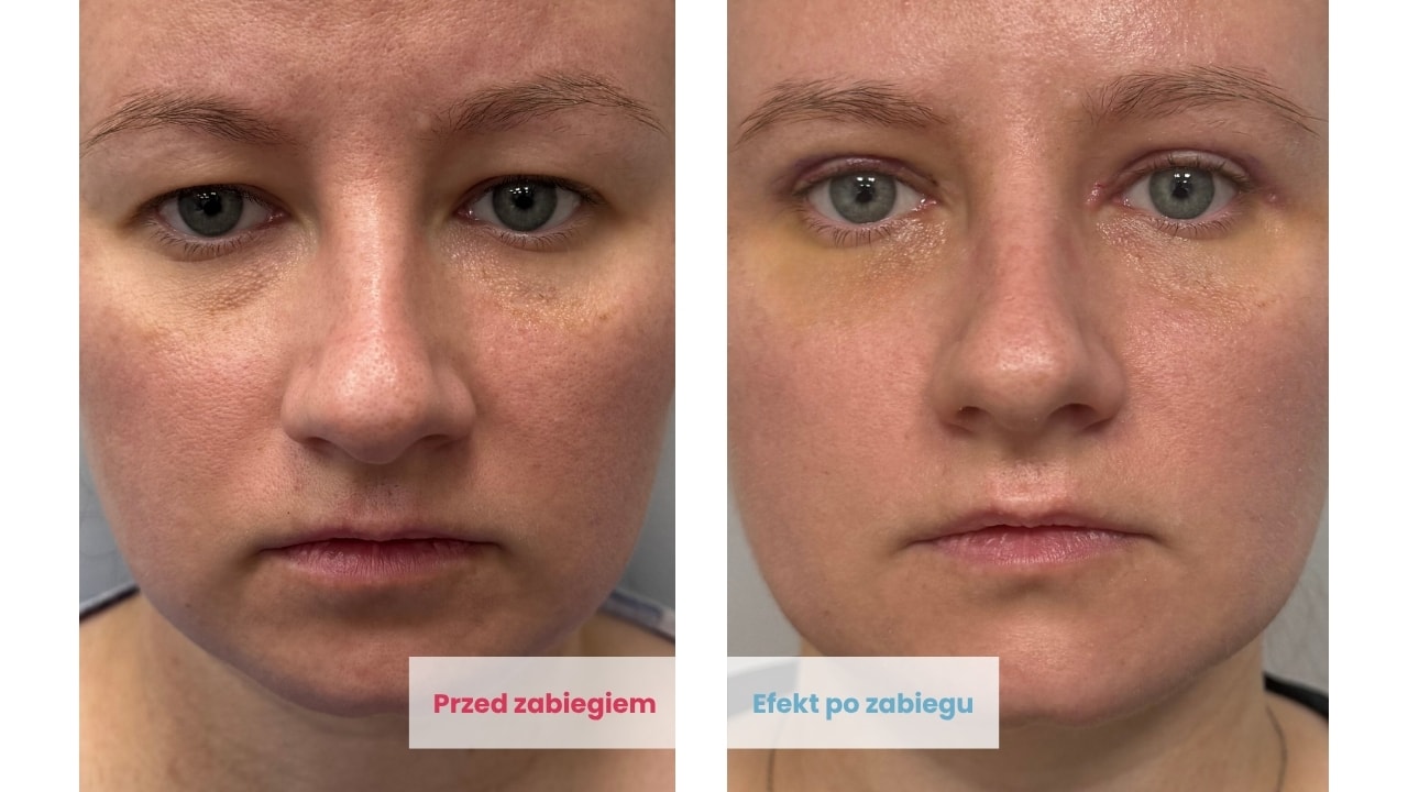 Efekty plastyki powiek górnych u Pacjentki kobiety