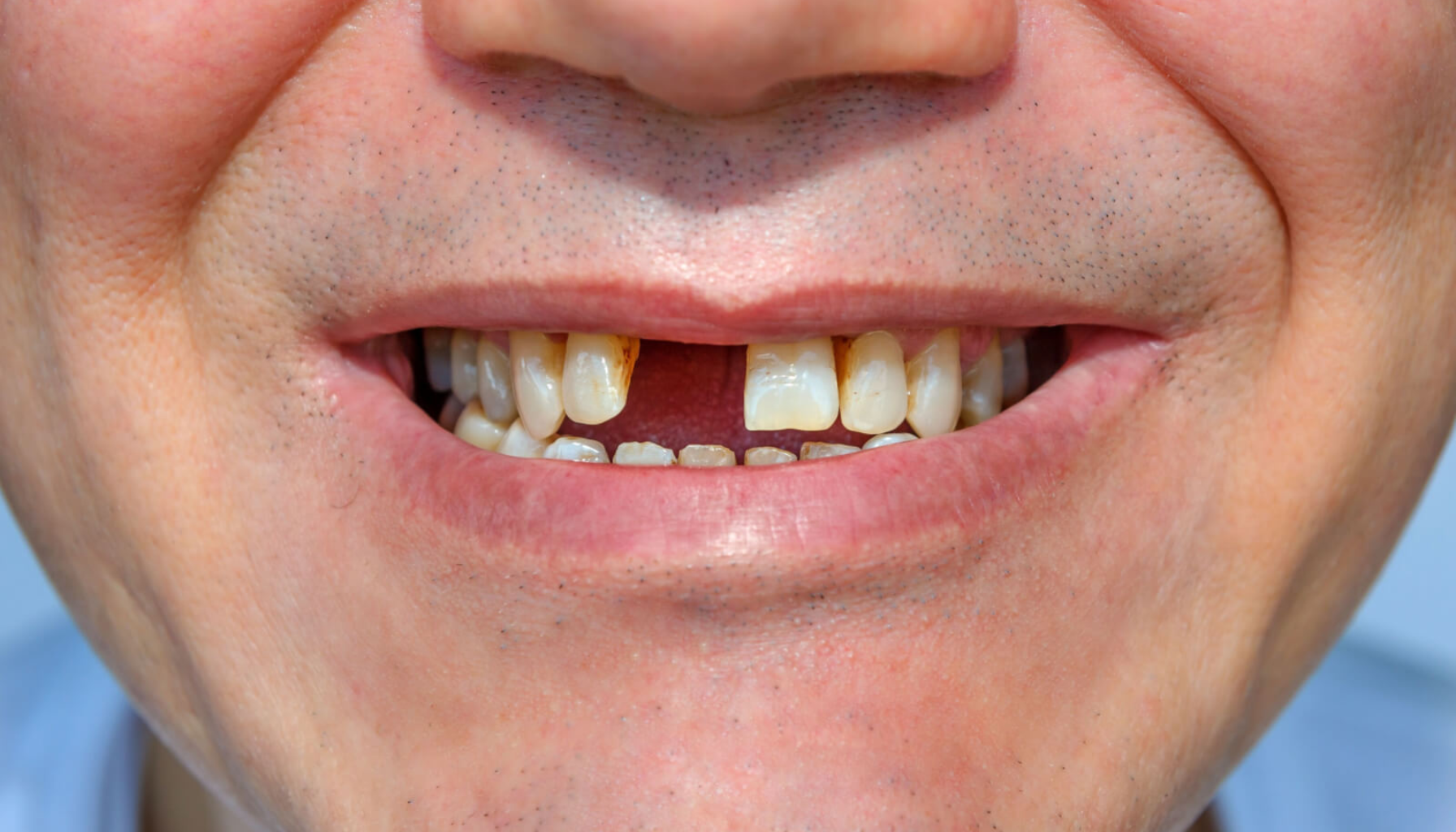 Tapptann: Når En Tann Går Tapt og Hva Du Kan Gjøre Videre 3 Nærbilde av munn med misfargede og ujevne tenner, viser behov for tannbehandling og forbedret munnhygiene hos voksne
