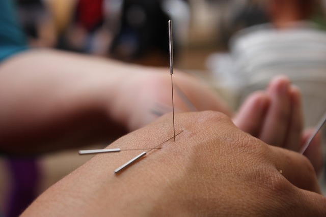 acupuncture, needles, hand