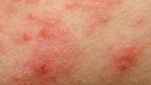 Allergic Eczema: Causes, Symptoms, and Diagnosis
