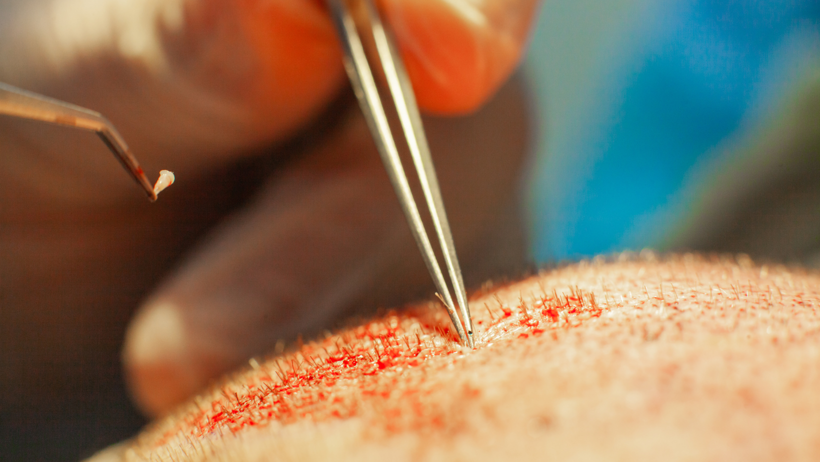 Factors to avoid for a successful hair transplant