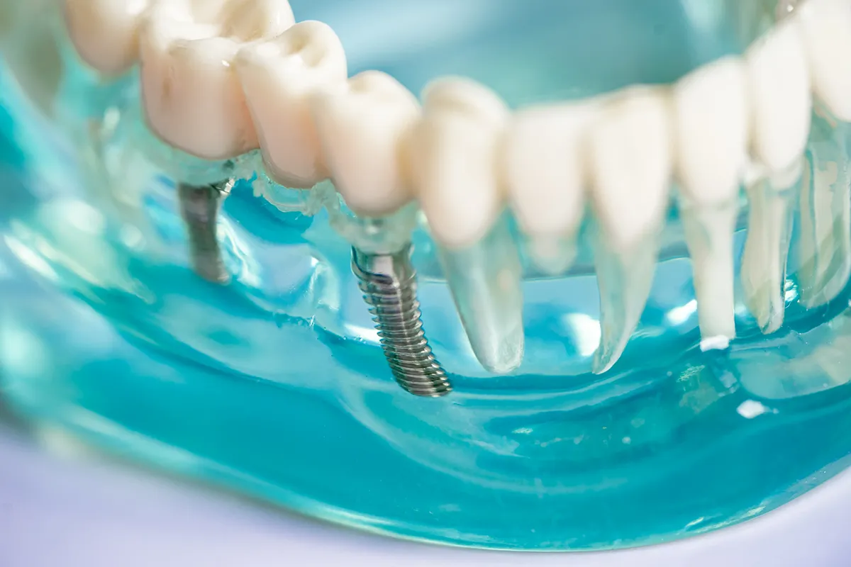 Dental implant model showing metal screw integrated with artificial teeth.