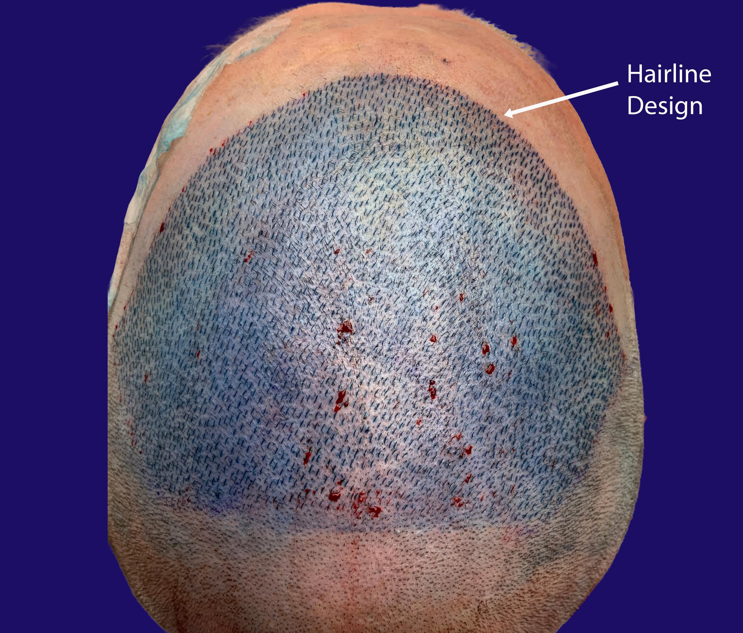 Dr Vikas Kunnure - Hairline incisions made by Dr Kunnure