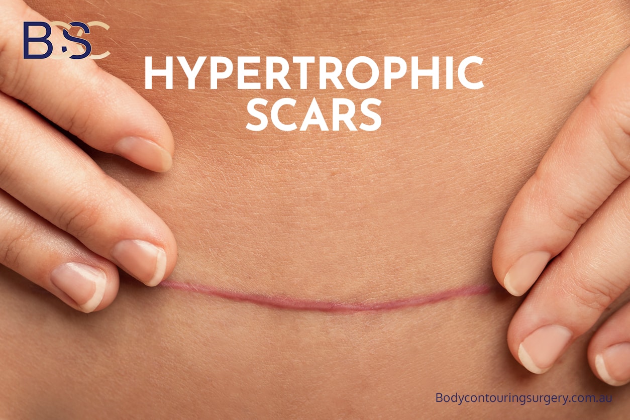 Hypertrophic scars | Body Contouring Surgery Clinic