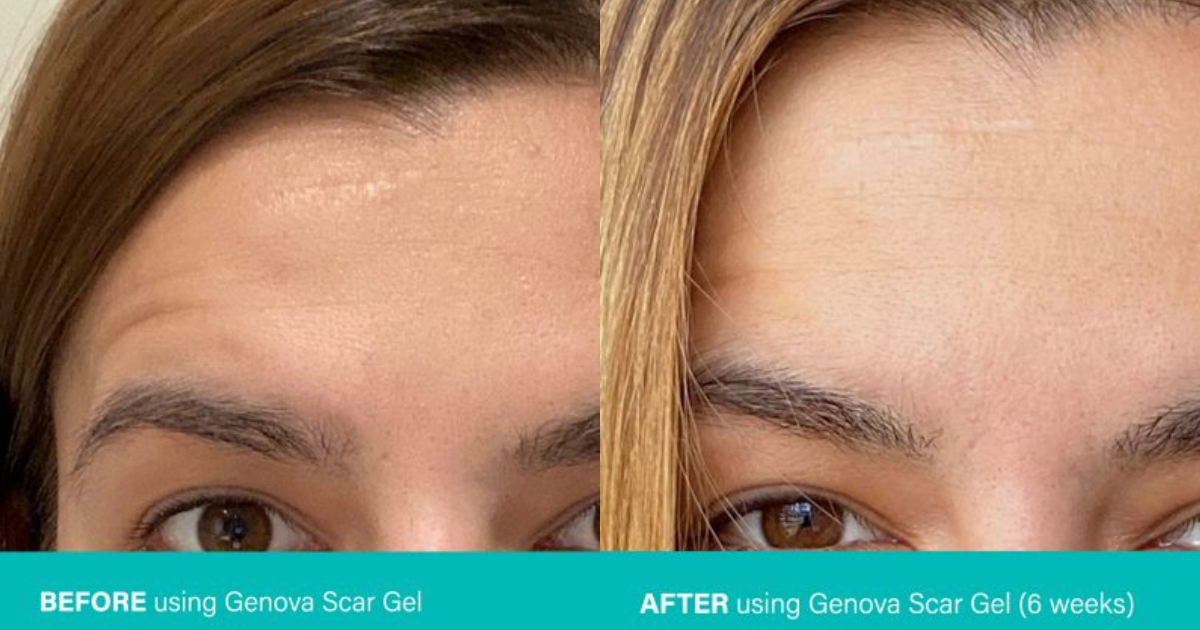 Real Life Success Story for Scar Gel