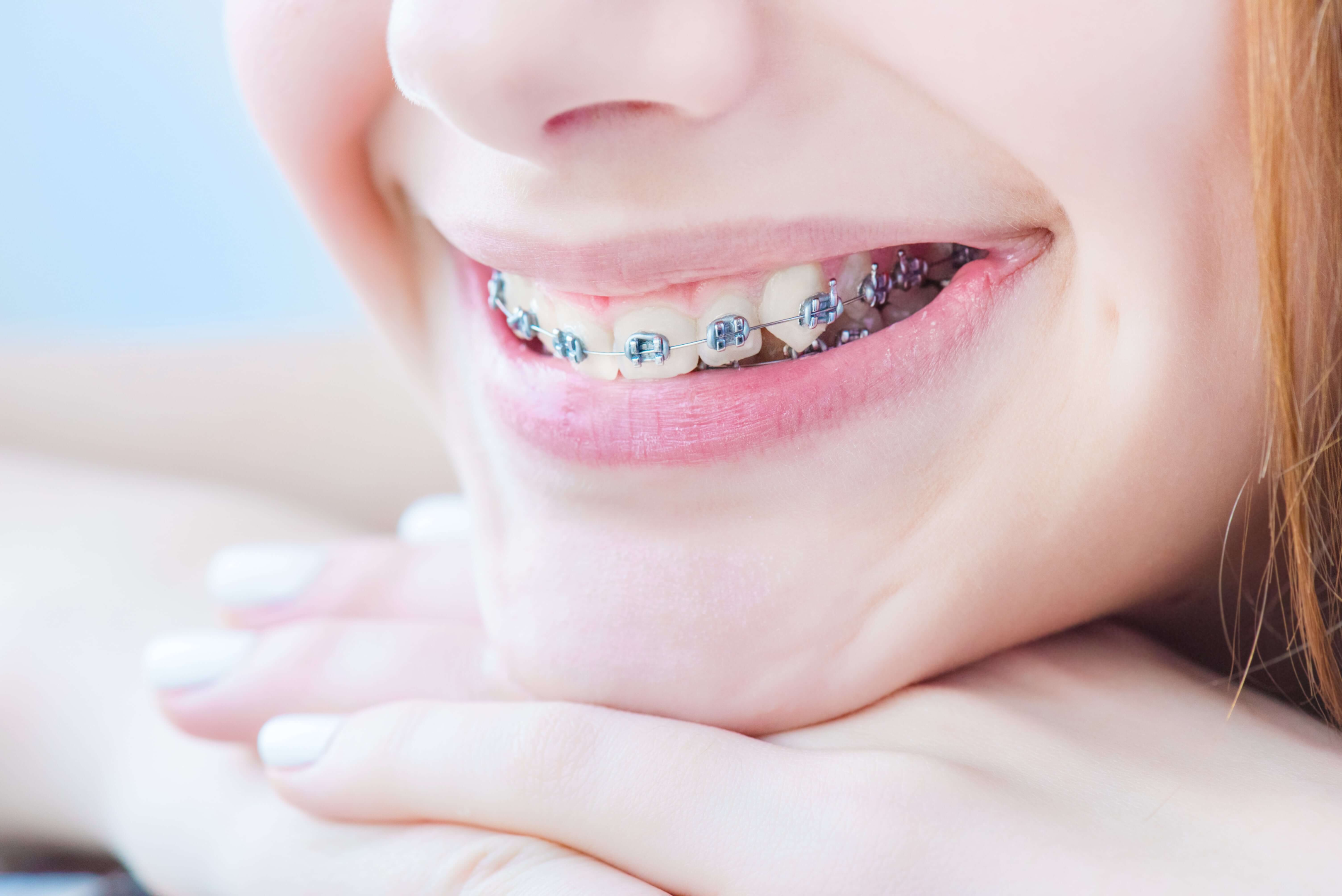 The Ultimate Guide to the Parts of Braces - Frey Orthodontics