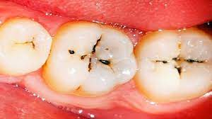 tooth enamel with cavities and oral diseases