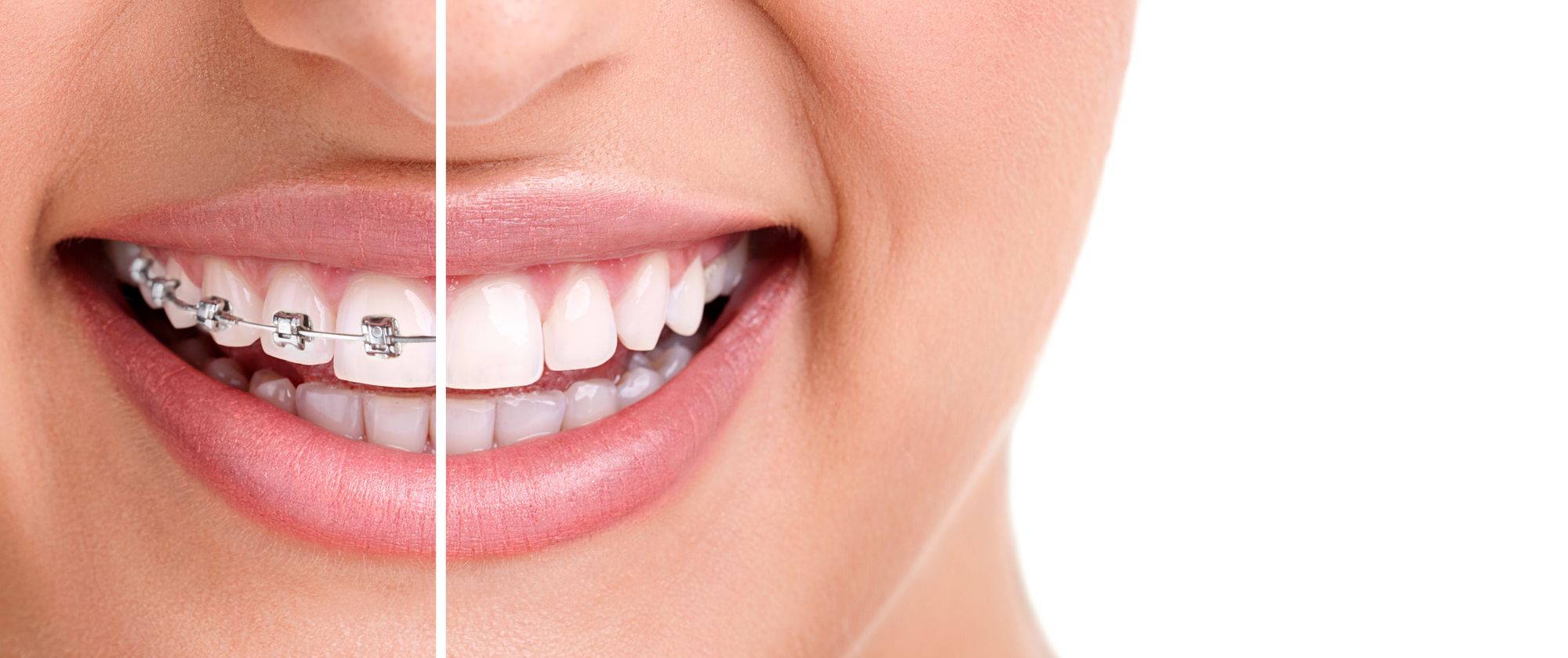 traditional braces vs clear aligner treatment