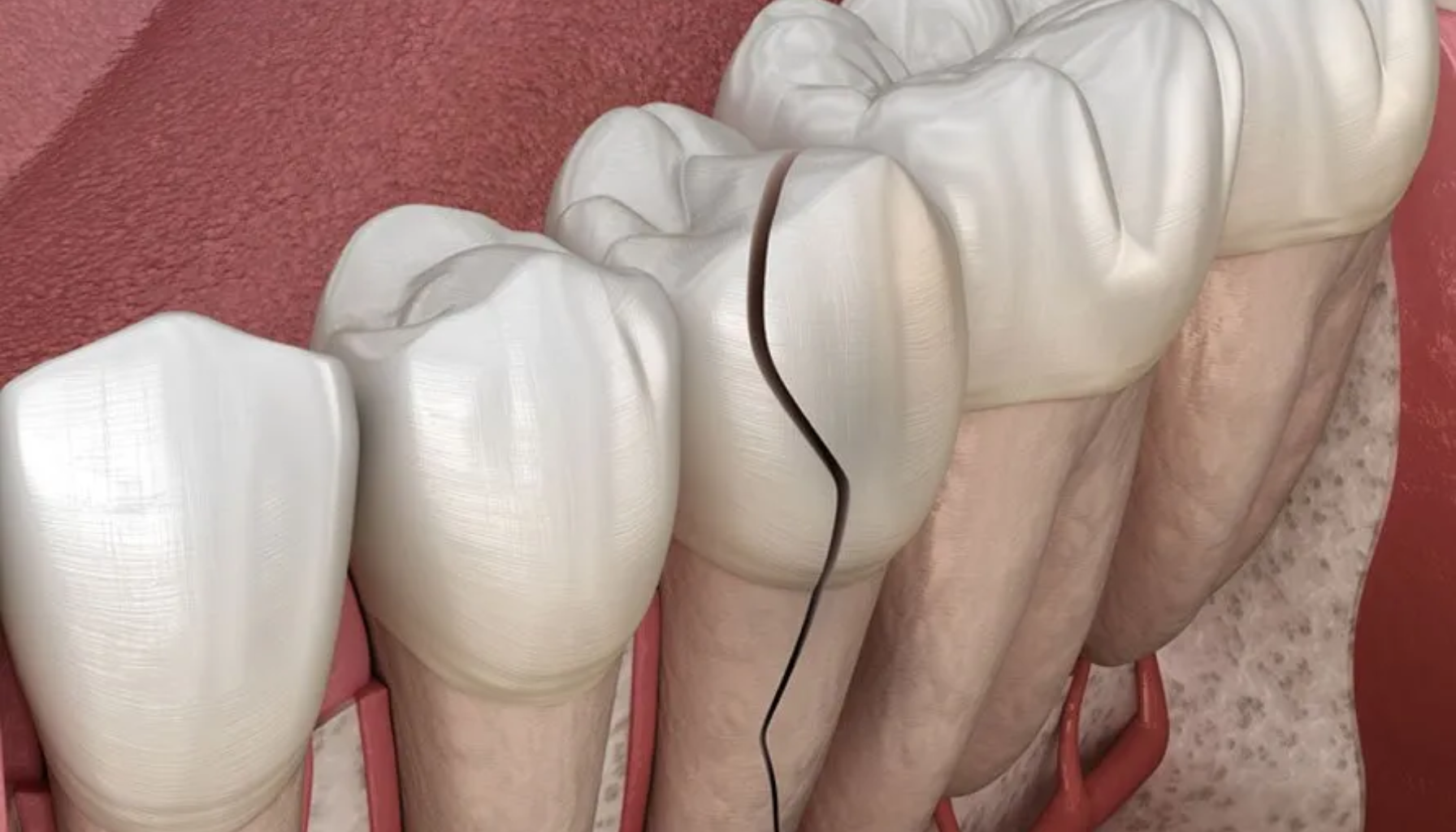 Illustrasjon av en sprekk i en jeksel, som viser en dyp fraktur fra tyggeflaten og ned mot tannroten.