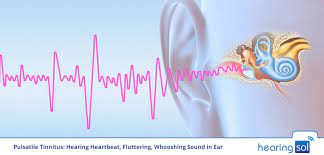 Pulsatile Tinnitus: Stop Hearing Heartbeat, Fluttering Sound