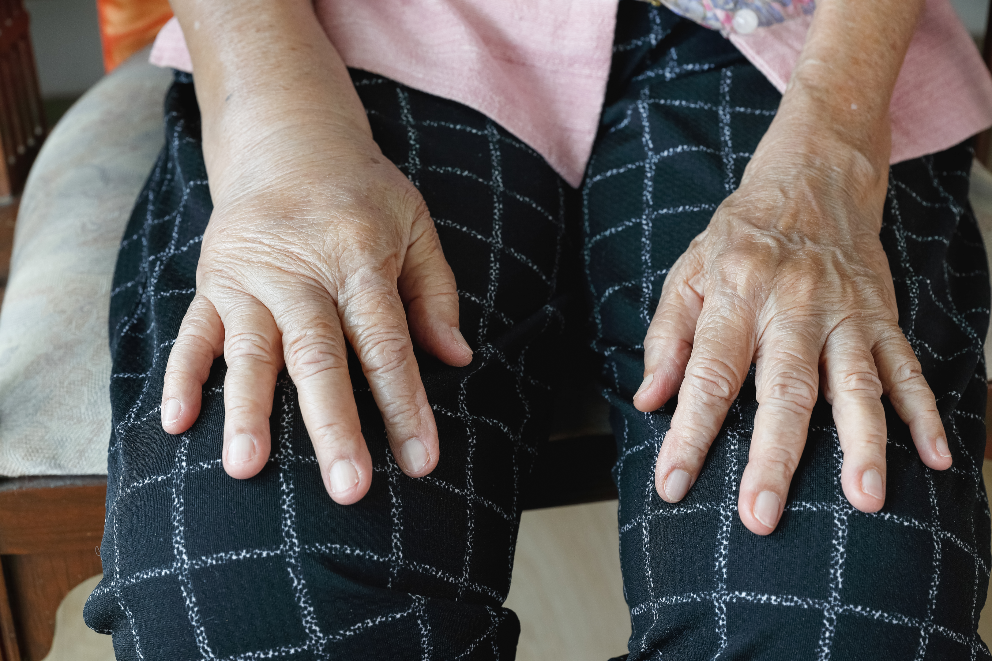 Swollen hands (non-painful) reflect thyroid abnormalities.
