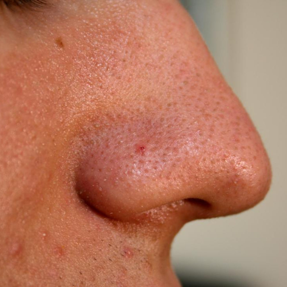  under eye concealer for acne skin