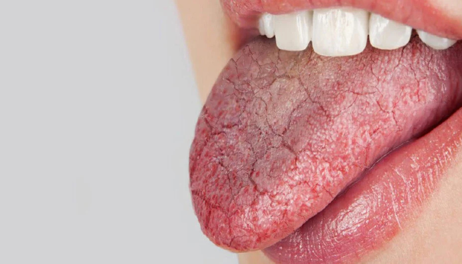 Munntørrhet og refusjon hos tannlegen – Slik fungerer det