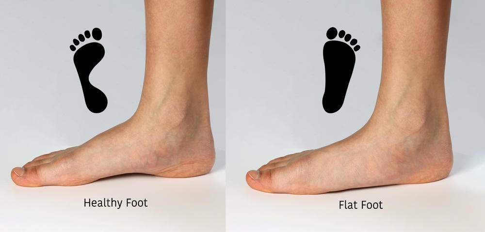 comparing healthy foot to flat foot