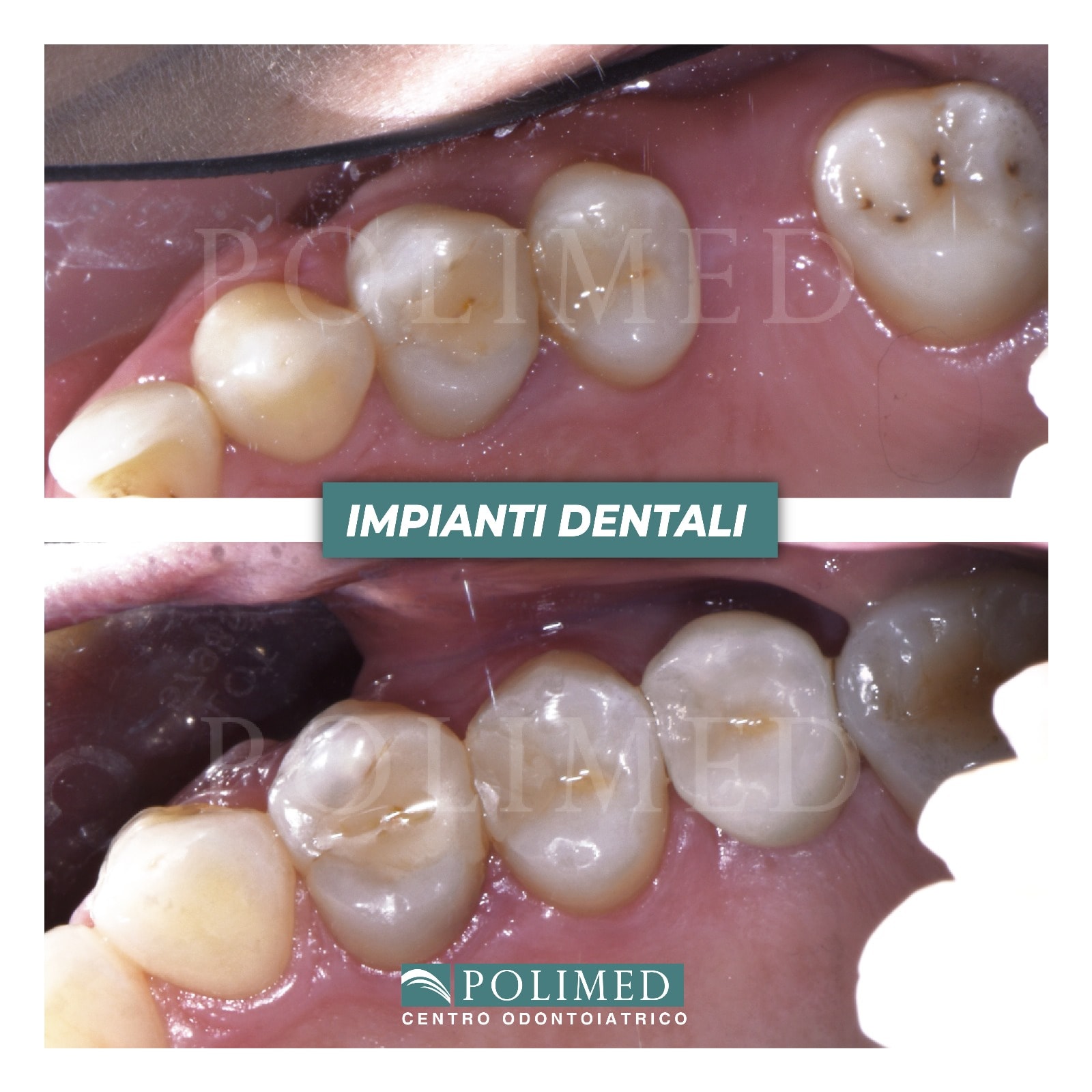 Comparazione tra impianto, ponte e protesi → Differenze tra impianto dentale, ponte e protesi mobile.