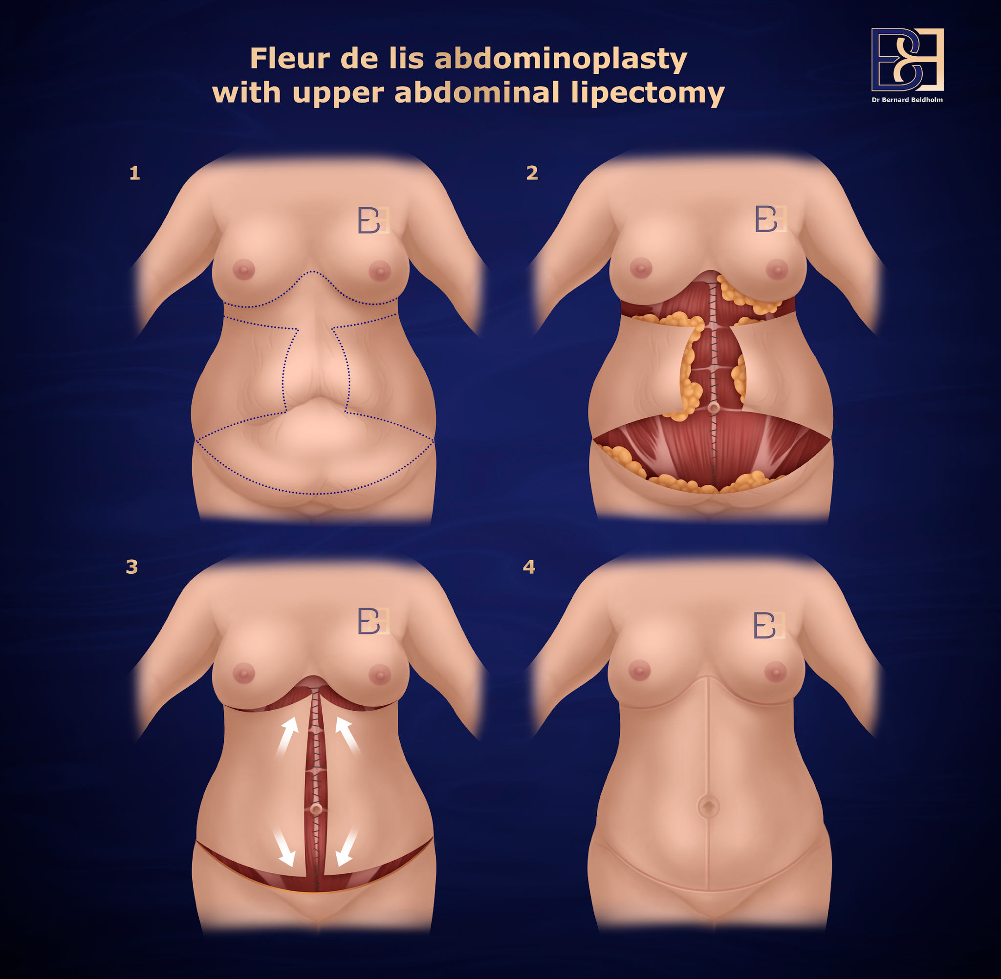 Dual vector abdominoplasty