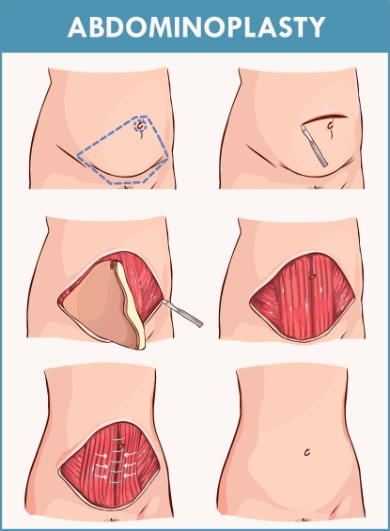 Una imagen del abdomen de una persona antes y después de la cirugía de abdominoplastia.