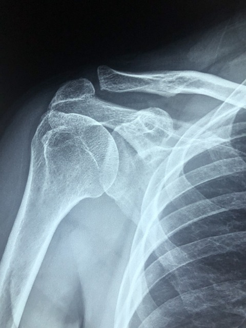 x-ray of rotator cuff