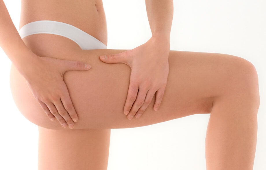 Primo piano di coscia destra appartenente ad una donna che controlla la presenza di cellulite nella parte superiore della gamba