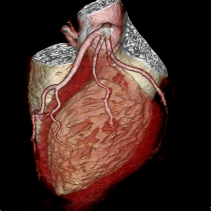 A CT coronary angiogram