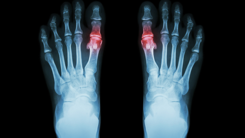 Im Röntgenbild sieht man die Ablagerungen der Harnsäurekristalle an den Gelenken der Zehen
