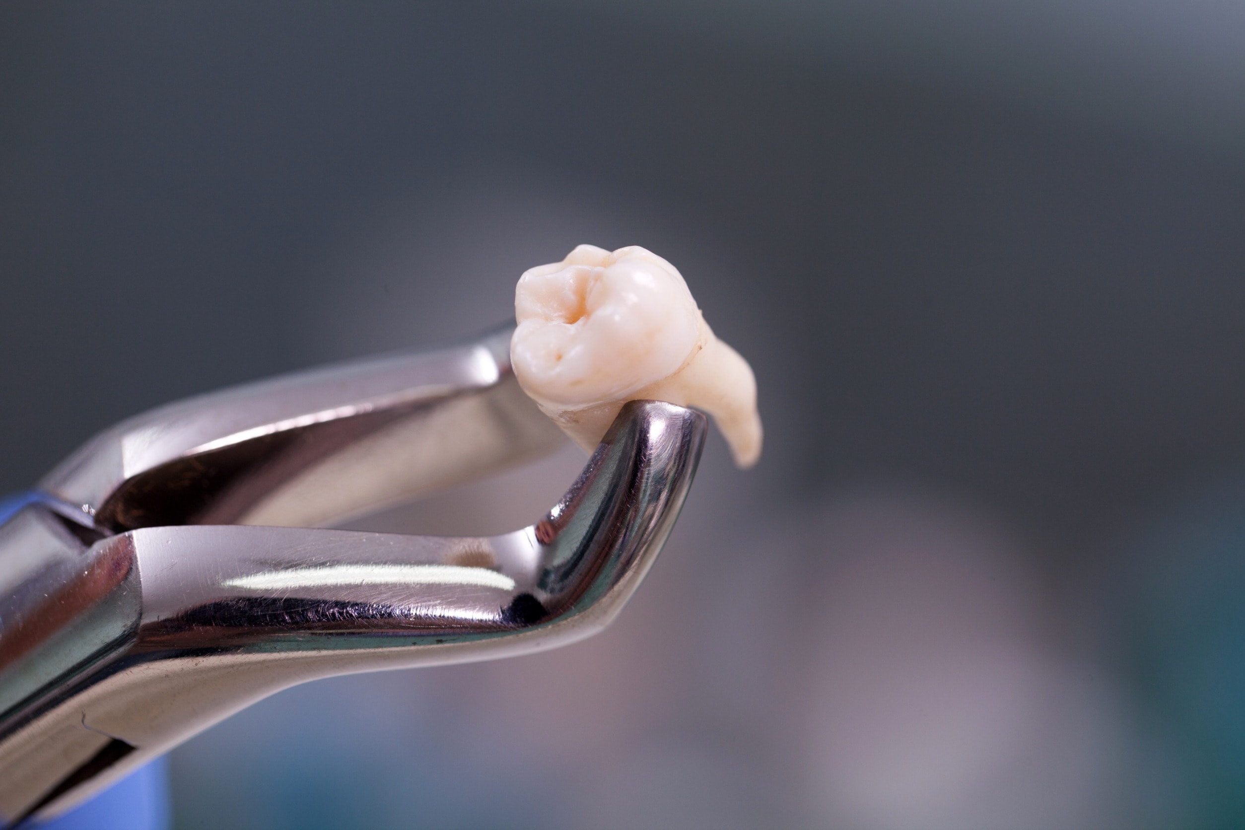 A dental extraction in progress with a tooth between pliers