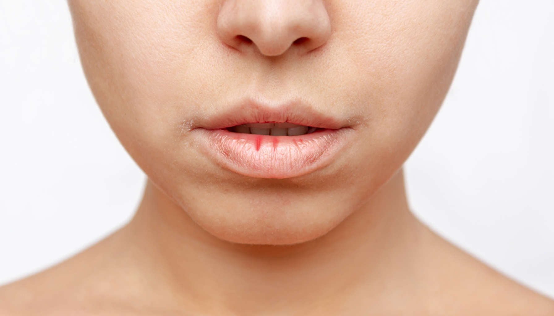 "Nærbilde av en persons munn med tørre og sprukne lepper, spesielt i munnvikene."